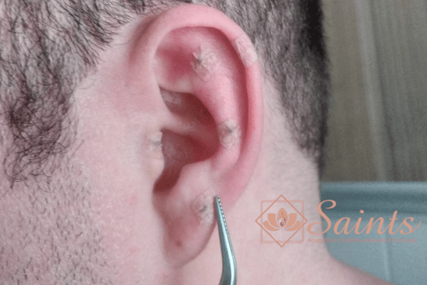 Imagem promoção auriculoterapia